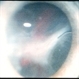 Proliferative Vitreoretinopathy (PVR)